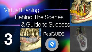 RealGUIDE Implant Planning Episode 3 [upl. by Corvin436]