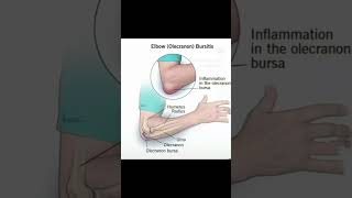 Olecranon bursitis is swelling redness and pain at the tip of the Elbow [upl. by Xanthus]