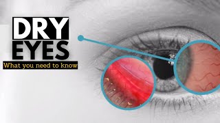 Dry Eye Syndrome Causes Signs and Symptoms Diagnosis and Treatment [upl. by Neffirg]