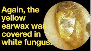 Again the yellow earwax was covered in white fungusear wax removal  ear cleaning  ASMR [upl. by Daggna]