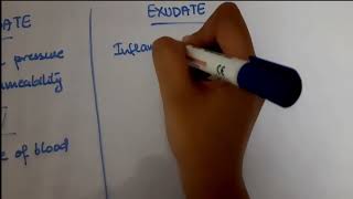 Pleural Effusion  EXUDATE vs TRANSUDATE  Lights criteria [upl. by Yllib]