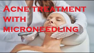 Acne treatment with microneedling [upl. by Aloin894]