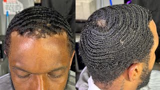 WAVES ARE KILLING HIS HAIRLINE Remedy [upl. by Jammin]