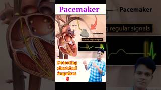 Pacemaker heart pacemaker shorts medical [upl. by Mckale]