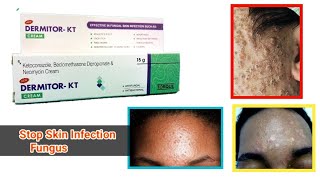 How to use Dermitor KT Cream  Beclomethasone Ketoconazole Dipropionate Neomycin  Antifungal [upl. by Ppik]