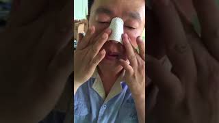 How to use nasal splints [upl. by Anoirtac615]