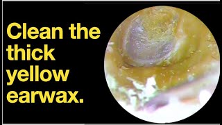 Clean the thick yellow earwaxear wax removal  ear cleaning  ASMR  relaxation  relax [upl. by Drapehs]