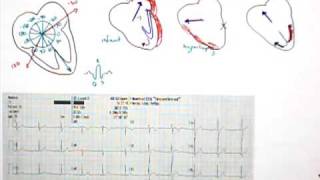 12 Lead EKG Part 5 QRS Axis [upl. by Aiam]