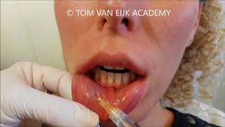 The Amsterdam Block local anaesthesia for numbing the lips [upl. by Alta]