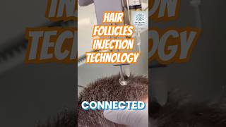 Hair Injection Technology techinnovation [upl. by Nellaf]