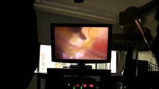 Cardiac denervation by uniport video assisted thoracoscopy [upl. by Nicolai854]