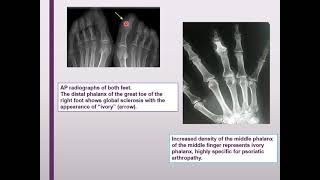 seronegative arithritis [upl. by Dewhirst]