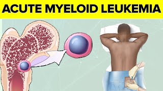 Acute Myeloid Luekaemia AML Explained Symptoms of AML Blood Tests for AML  Risk factors for AML [upl. by Swanson]