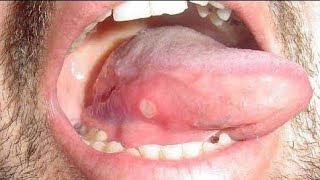 Causes of mouth and tongue ulcers and ways to treat them as quickly as possible [upl. by Tremain]