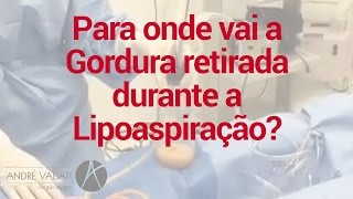 Para onde vai a gordura retirada na Lipoaspiração Cirurgia Plástica Porto Alegre  André Valiati [upl. by Guido]