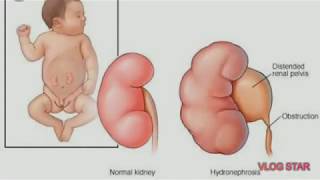 What is Hydronephrosis CausesSymptoms amp treatment in Bengali [upl. by Annaujat]