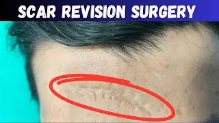 scar revision surgery for forehead scar Scar revision surgery scarrevisionsurgery [upl. by Weathers448]