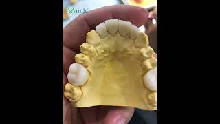 Zirconia crown with Vsmile ST multilayer 🤩 [upl. by Adlesirc]