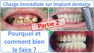 Dents fixes sur implant  Charge immédiate  Part 2 [upl. by Fruma]