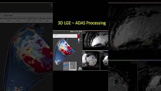 Cómo la Resonancia Cardíaca y el Software ADAS Transforman la Ablación de Taquicardia Ventricular [upl. by Netsreik]