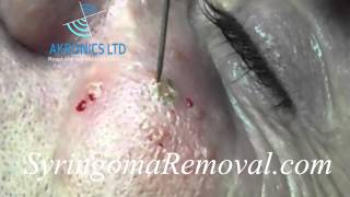 Syringoma Removal using ElectroFulguration [upl. by Dante]