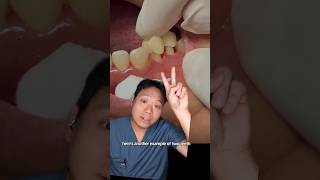 Dentist Explains Cementing Porcelain Crown crown porcelain dentalprocedure restoration [upl. by Frierson941]