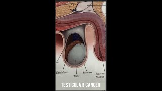 Testicular cancer [upl. by Yesdnik]