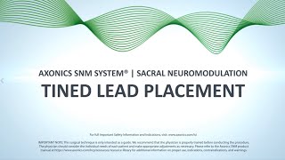 Tined Lead Procedure  Axonics SNM System® [upl. by Kania]