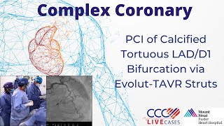 Live Complex PCI of Calcified Tortuous LADD1 Bifurcation via EvolutTAVR Struts [upl. by Heydon521]