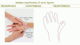 Seddons classification of nerve injurybackbenchers revolution [upl. by Zitella]