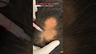 What Millenials Think About Alopecia Treatment  Viral shorts [upl. by Werner]