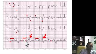 INTERPRETACION EKG EXTRASISTOLES VENTRICULARES [upl. by Alleyne]