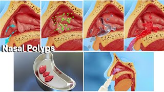 Nasal polyps treatment and surgery 3d medical animationDandelion Team nasalpolyp noose [upl. by Mungo]