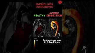 Aortic Dissection EnergyLoss [upl. by Yemane]