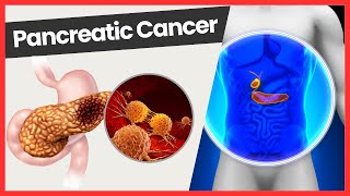 Understanding Pancreatic Cancer Symptoms Risks and Prevention  A Must Watch [upl. by Nelrac]