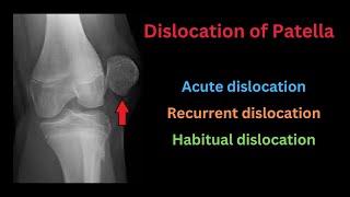 Dislocation of Patella Causes Types Pathology Clinical features Treatment amp Complications [upl. by Hsihsa502]