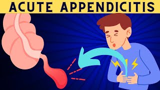 Acute Appendicitis Signs And Symptoms Risk Factors Diagnosis And Treatment [upl. by Eceinahs]