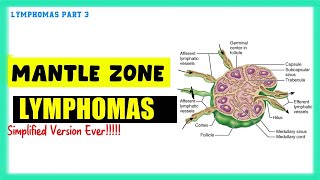 Mantle Zone Lymphoma Simplified  Speedy Medical [upl. by Aerona]