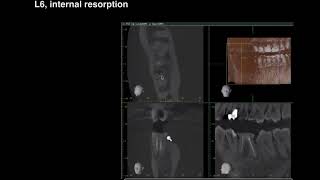 Internal resorption with perforation [upl. by Nonek149]