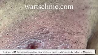 Molluscum self treatment causing deep skin infection and abscess [upl. by Sharline378]