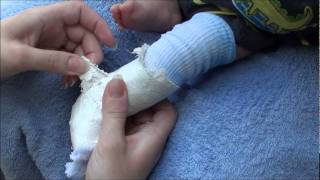 How to remove a fiberglass and plaster cast from an infant [upl. by Tnarb]