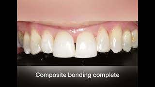 InvisalignWhiteningComposite Bonding [upl. by Hnoj]