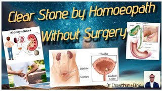 Cure Stone Without Any Surgery l Dr Chowdhury Clinic l Kidney Stone l Gall Stones l Urinary Stone [upl. by Ordisy]