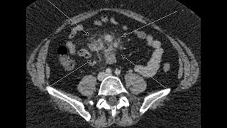 Mesenteric Panniculitis or Sclerosing mesenteritis [upl. by Clemence]