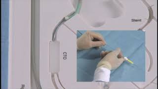 Angioplasty technique an antegrade approach for CTO English subtitle [upl. by Isbel]