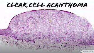 Clear Cell Acanthoma with PAS Stain 5Minute Pathology Pearls [upl. by Esinart]