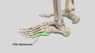 Surgical Management of Fifth Metatarsal Jones Fractures Intramedullary Screw Fixation [upl. by Oer]