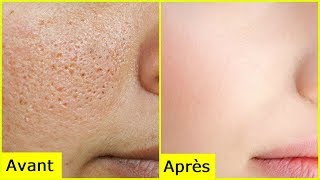 Voici comment Supprimer les pores dilates du visage  Allez Santé [upl. by Ahsekam392]