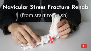 Navicular Stress Fractures  Causes Diagnosis and Treatment [upl. by Michaeline]