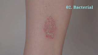 04 Common Causes of Skin Rashes [upl. by Eleaffar]